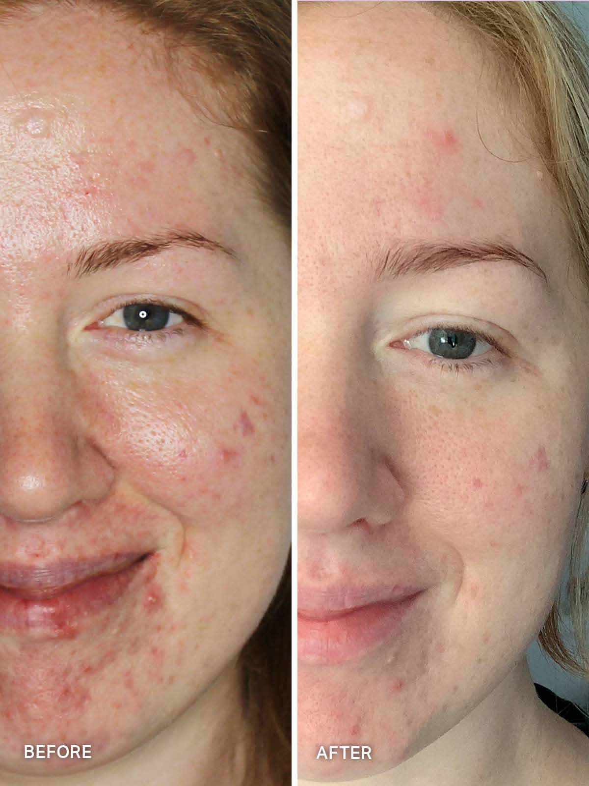 Clear Skin Starter Kit