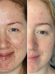 Clear Skin Starter Kit